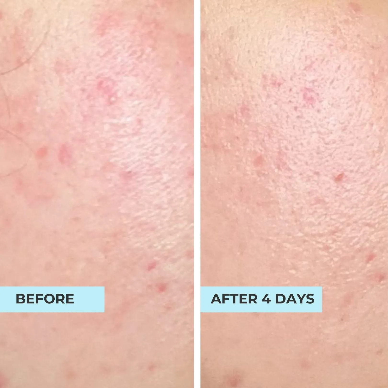 Bumpy, Textured and Dull Skin Kit