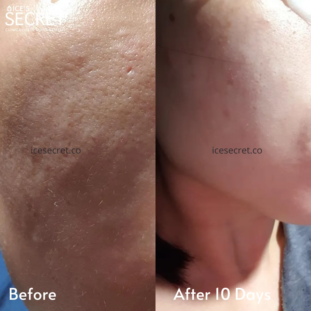 Bumpy, Textured and Dull Skin Kit